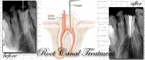 root canal treatment